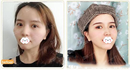 成都銅雀臺(tái)多方面部自體脂肪填充果對(duì)比圖