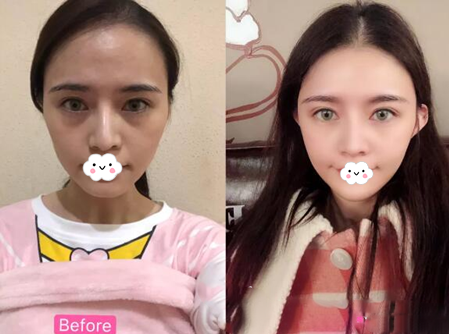 成都銅雀臺(tái)玻尿酸填充多方面部術(shù)后果圖