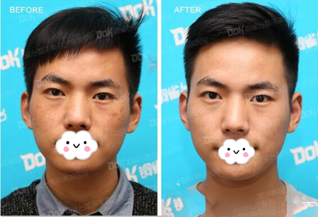 成都銅雀臺(tái)激光美膚祛斑術(shù)后果對(duì)比圖