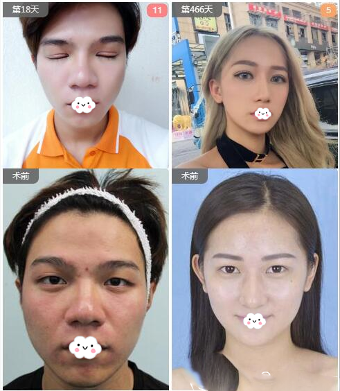 南寧華美林勇做的雙眼皮案例前后對比圖