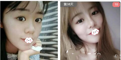 南寧華美趙麗紅膨體隆鼻案例