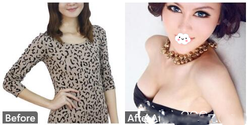 南寧華美趙麗紅假體隆胸案例術(shù)后2年反饋圖