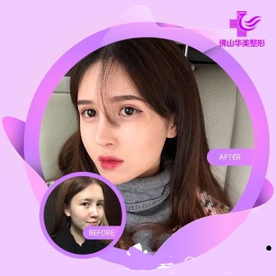 佛山華美整形美容醫(yī)院隆鼻術(shù)病例比較