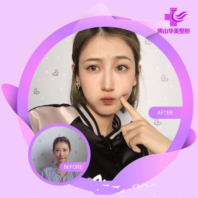 佛山華美醫(yī)用整形美容醫(yī)院透明質(zhì)酸注射液