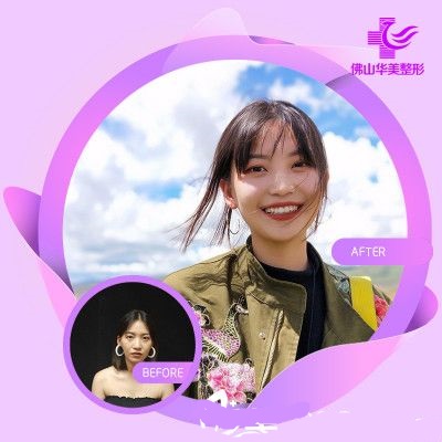 佛山華美整形美容醫(yī)院多方面部自體脂肪填充病例分析