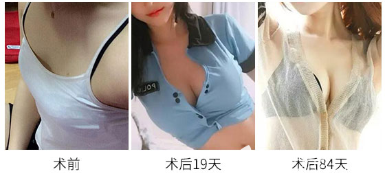 梁宗建院長在佛山華美做假體隆胸案例