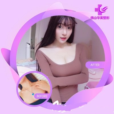 佛山華美整形美容醫(yī)院假體隆胸病例比較