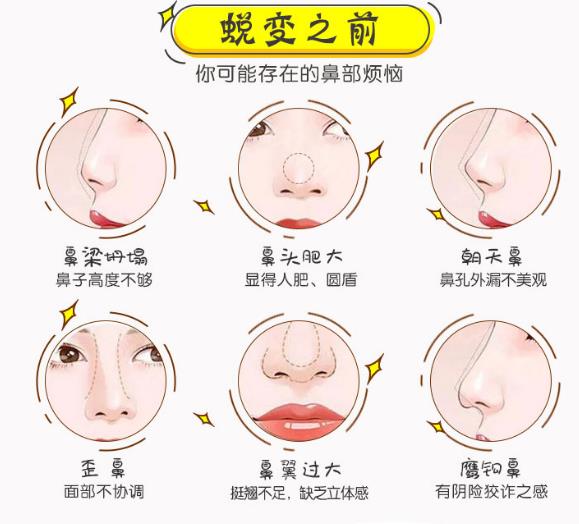 鼻翼縮小手術(shù)過程