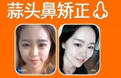 蒜頭鼻確實(shí)難看，蒜頭鼻整形對(duì)比照相片快點(diǎn)送上！