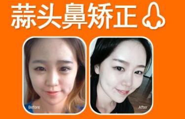 蒜頭鼻確實(shí)難看，蒜頭鼻整形對(duì)比照相片快點(diǎn)送上！
