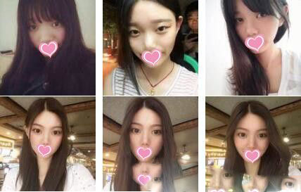 上海佰思愛醫(yī)療美容門診部全切雙眼皮真人案例