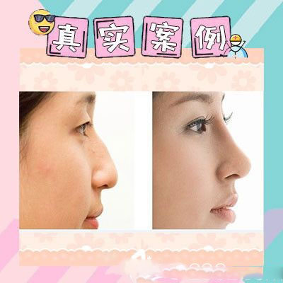 廣州翊美醫(yī)療美容醫(yī)院祖秉毅院長做的隆鼻案例
