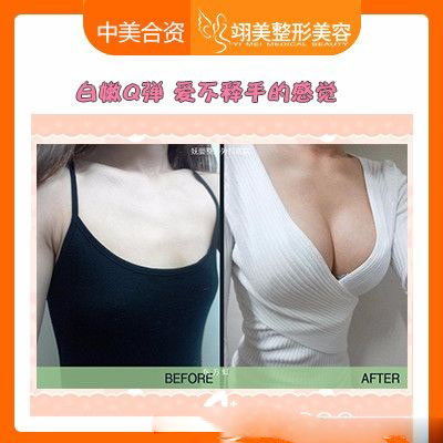 廣州翊美祖秉毅院長做的假體隆胸案例