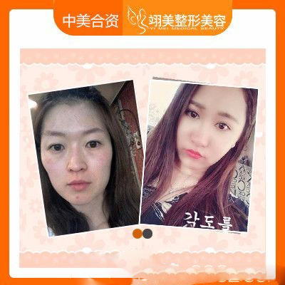 廣州翊美祖秉毅院長做的自體脂肪面部填充案例