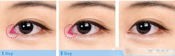 微創(chuàng)眼內(nèi)開(kāi)角術(shù)