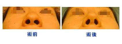 手術(shù)的并發(fā)癥