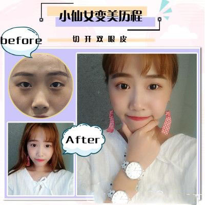 珠海愛思特李德新雙眼皮案例