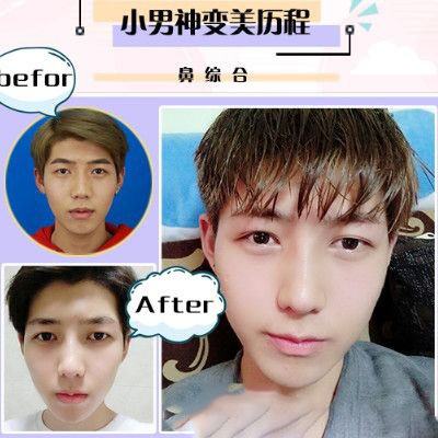 珠海愛思特李德新鼻部手術(shù)隆鼻案例