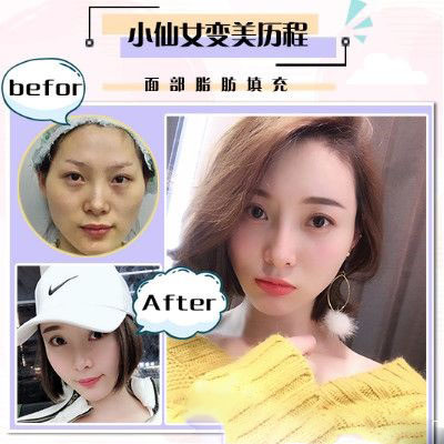 珠海愛思特面部脂肪填充案例