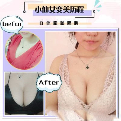 珠海愛思特李德新自體脂肪豐胸案例