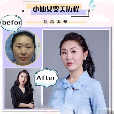 珠海愛思特超激光美膚祛斑案例案例