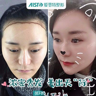 珠海愛思特李德新做的復合隆胸案例