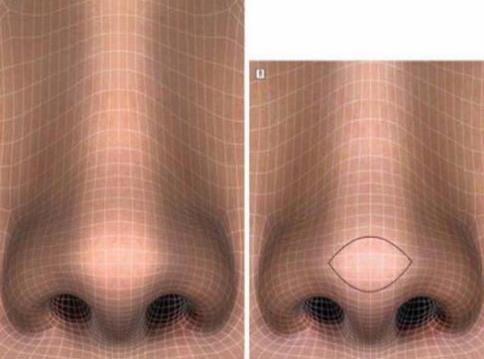 鼻頭縮小手術(shù)后的護(hù)理