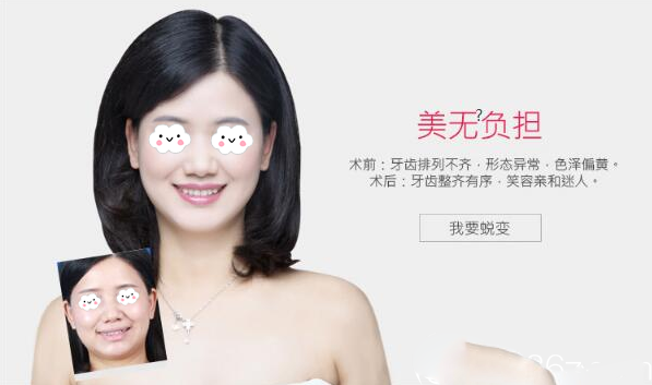 珠海愛思特隱形牙齒矯正案例對比圖