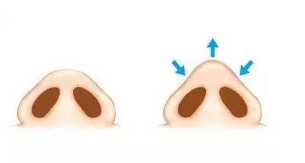 2020年鼻頭縮小手術(shù)要多少錢(qián)價(jià)錢(qián)收費(fèi)詳細(xì)信息~