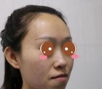 深圳梁曉健鼻子整形做的好嗎？送上隆鼻實(shí)例果圖