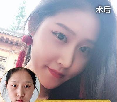 硅膠隆鼻的缺點