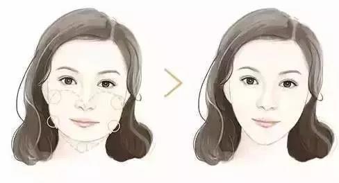 玻尿酸瘦臉？玻尿酸還有這種神奇的功？