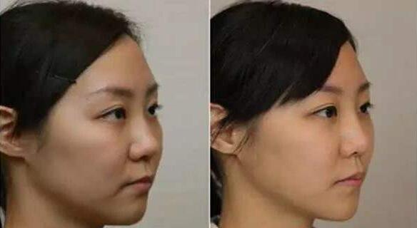 拉皮手術(shù)概念