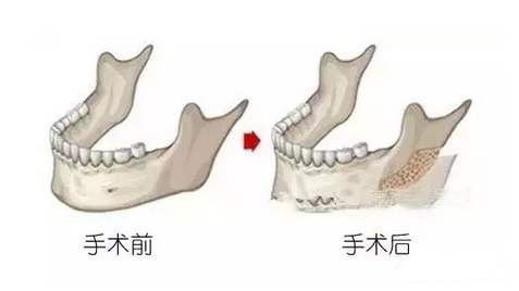 兩年前做了下頜角截骨手術(shù)，如今來(lái)給大家科普一下！