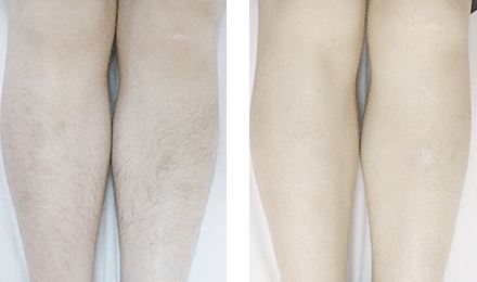 激光脫毛的特點