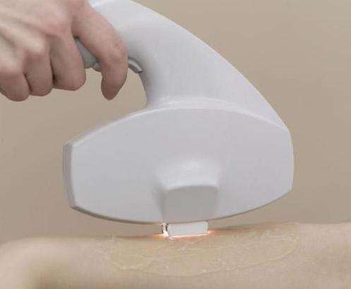 激光脫毛的調(diào)節(jié)果