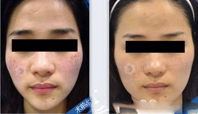 激光祛斑前后對(duì)比果