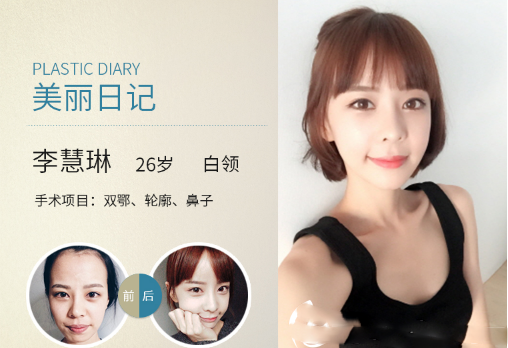 東莞美極醫(yī)療美容隆鼻案例