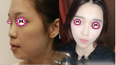 北京、歐美羊腸線嵌入推廣案例研究