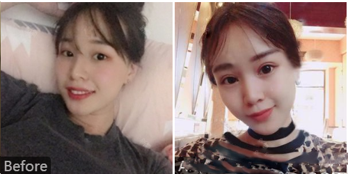 深圳、美國、加拿大陳群總裁雙眼皮切口案例圖