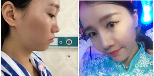 圖為深圳、美國、加拿大、周國偉隆鼻一例