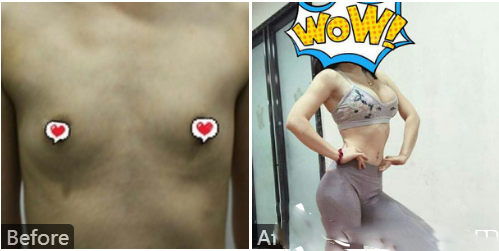 深圳、美國、加拿大、張志勇自體脂肪隆胸病例圖