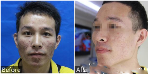 李莉點(diǎn)陣激光祛痘案例對比圖