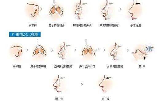 駝峰鼻手術(shù)調(diào)節(jié)價錢花費詳解