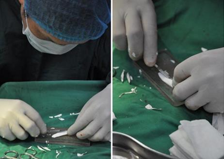 假體隆鼻術(shù)后感染癥狀