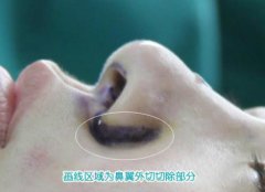 鼻翼縮小術(shù)的價(jià)錢大約多少？花費(fèi)詳細(xì)信息