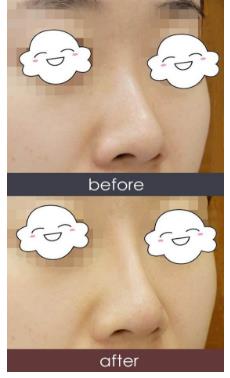 注射隆鼻的優(yōu)勢