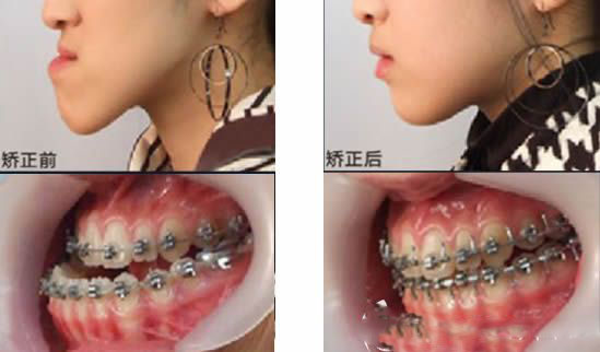 深圳世紀河山口腔高難度地包天矯正案例果