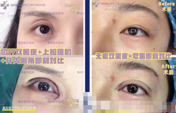 高培培醫(yī)生雙眼皮案例圖