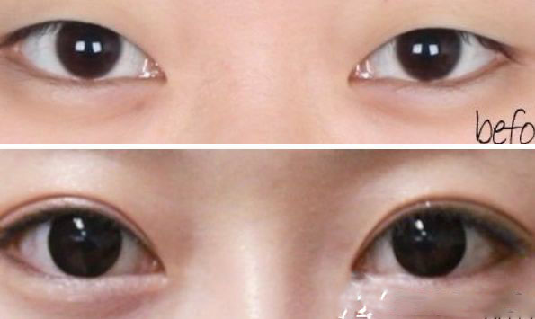 軍隊(duì)總醫(yī)院重瞼整容術(shù)2例